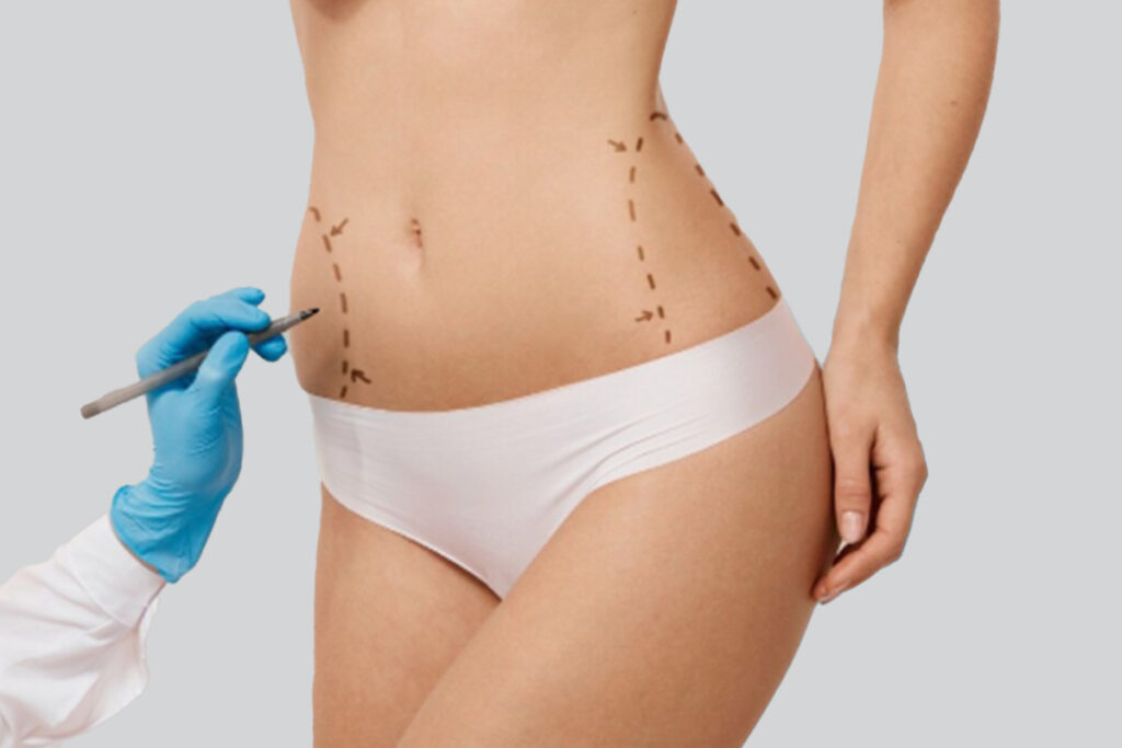 Buikwandcorrectie in Turkije