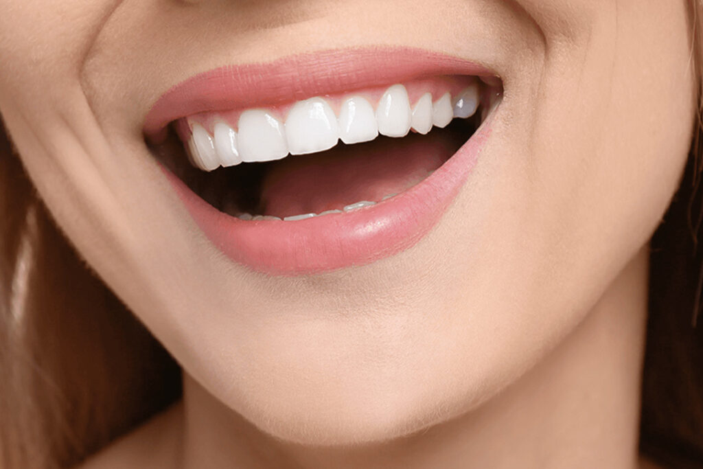 Hollywood Smile in Turkije