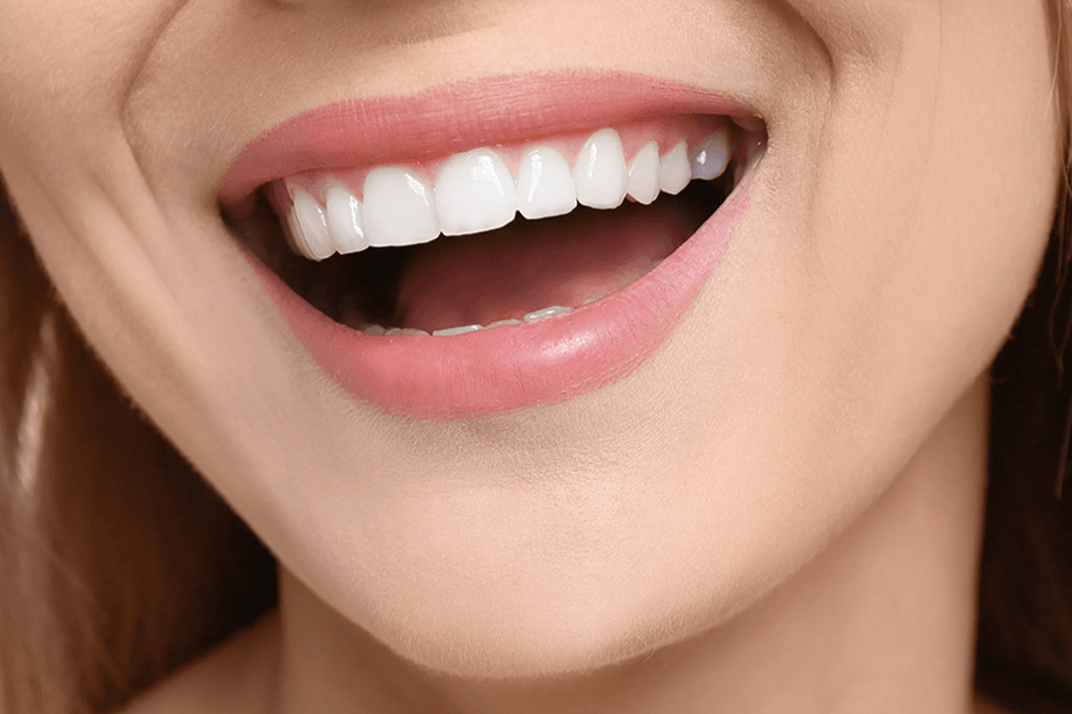 Hollywood Smile in Turkije